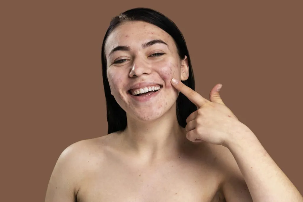 Smiley Woman Showing Her Acne With Confidence